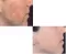 Acnaquit gel 50ml - thumbnail 1