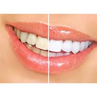 Kliknite za detalje - Ultra White Trake za izbeljivanje zuba 14 trakica